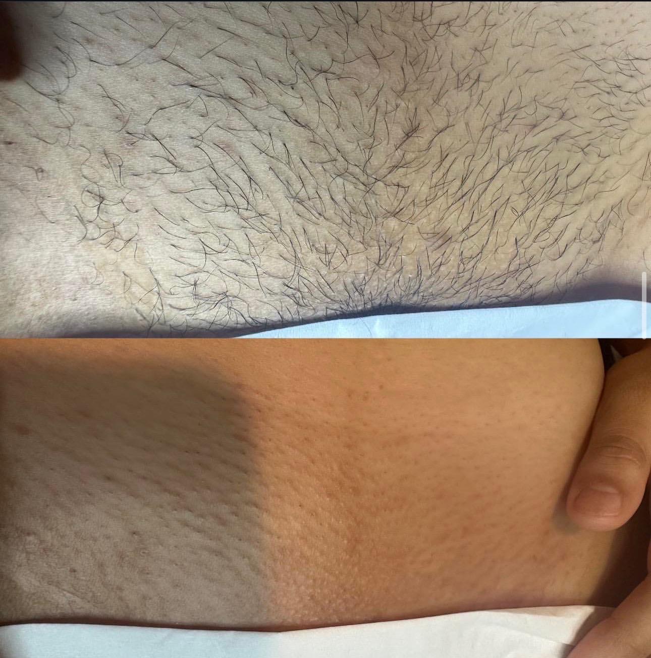 Waxing result slide 1